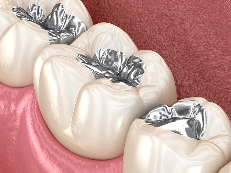 銀歯が身体に及ぼす影響（メタルフリー）