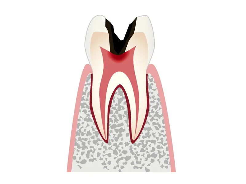 C3 神経の虫歯