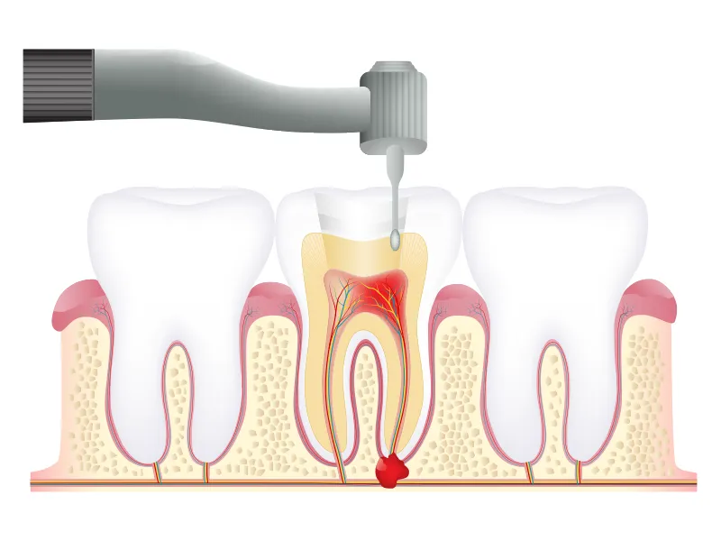 虫歯、神経の除去と根管拡大